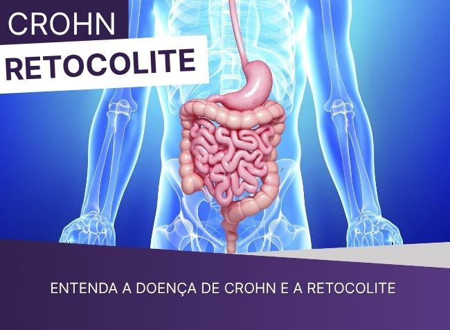 Entenda a Doença de Crohn e a Retocolite